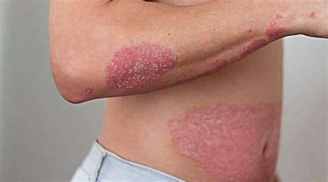 Man receives fatty liver diagnosis after rash spreads across body ...