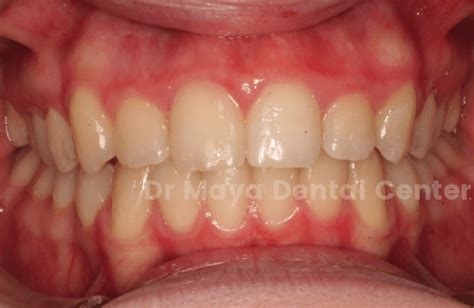 Smile Gallery - Orthodontic Braces