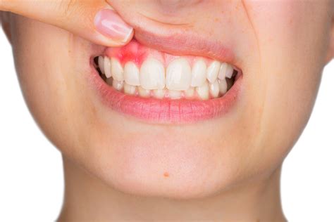 The Best And Most Effective Ways To Treat Mouth Sores - Vinnin Square ...