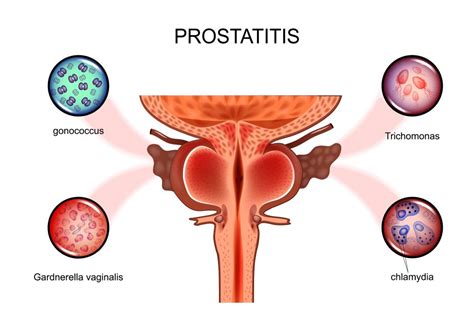 Chronic Epididymitis: Causes, Symptoms, Diagnosis, Treatment | STD.GOV Blog