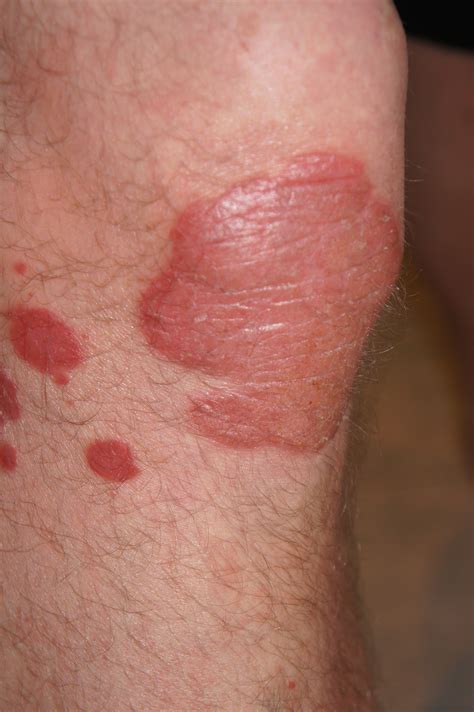 Psoriasis Pictures - View Free Images of Psoriasis