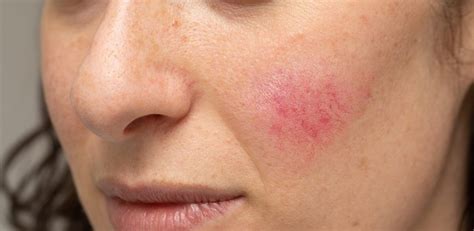 Rosacea: symptoms, causes and treatment