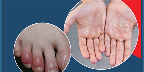 Chilblains- Causes, Treatment and Home Remedies | Onlymyhealth