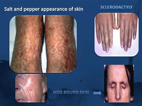 Systemic sclerosis..scleroderma