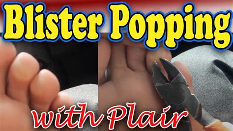 Popping giant burn blister - YouTube