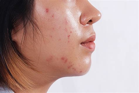 Powerful Home Remedies for Acne — AENO