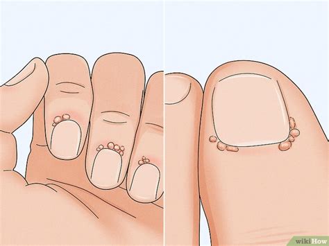 Periungual Warts: Symptoms, Treatment, and Prevention