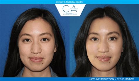 Asian Jawline Reduction - Los Gatos, CA: CA Aesthetics