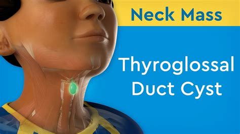 Neck Mass: Thyroglossal Duct Cyst - YouTube