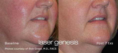 Is Laser Genesis for Acne Scars Effective?