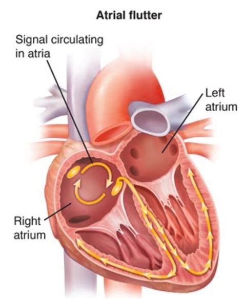 Atrial flutter symptoms - ladegdc