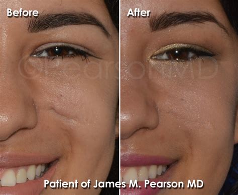 Scar Revision Photos - Before & After - Dr. James Pearson Facial Plastic Surgery
