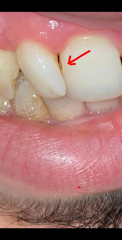 I noticed a hole between my front teeth. Is this a cavity or a stain? I honestly don’t know if ...