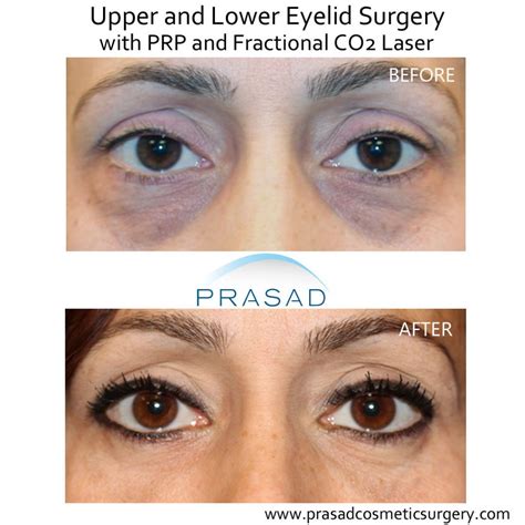 Benefits of PRP Injection Under Eyes - Dr. Prasad | New York