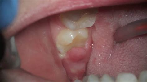 what's this sore gum on wisdom tooth - pericoronitis - YouTube