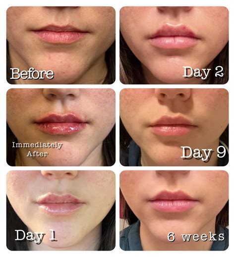 Lip Fillers: Before And After - What To Expect