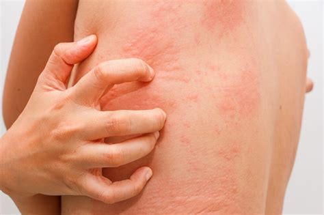 Hives Treatment and Remedies | U.S. Dermatology Partners