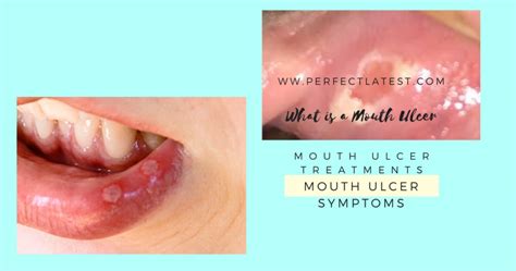 What Is A Mouth Ulcer :- Top 7 Mouth Ulcer Treatments, Mouth Ulcer ...