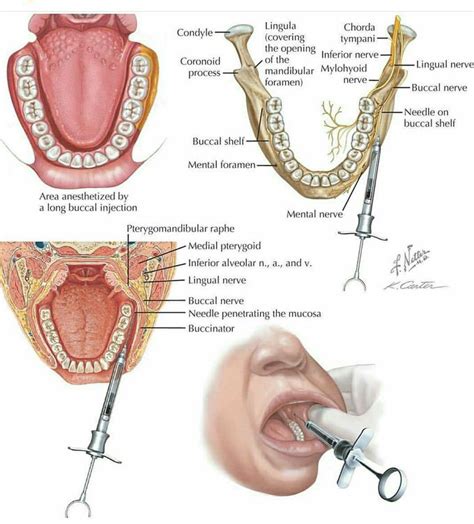 Correct long buccal nerve block technique - MEDizzy