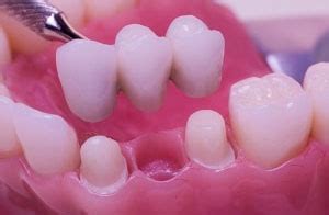 Fixed prosthodontics - Definition of Fixed prosthodontics