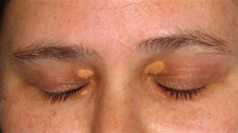 How Do I Remove Cholesterol Deposits Under Eyes