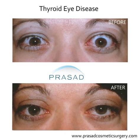 Thyroid Eye Disease Surgery/ Graves Eye Disease Surgery