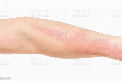 Asian Man Allergy Has Red Rash On Left Arm On White Background Stock ...