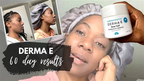 How I Treat My Acne Scars | 60 Day Results Using Derma E Scar Gel and Reduce Acne Scars Set ...