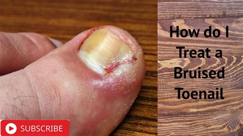 How do I Treat a Bruised Toenail - YouTube