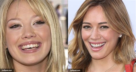 21 Celebrities with Dental Implants or Cosmetic Dentistry