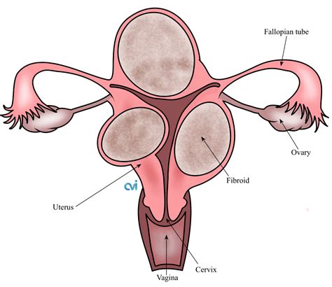 Large Fibroid Uterus Specialist For Effective Treatment