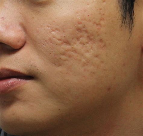 Best acne treatment for sensitive skin | General center | SteadyHealth.com