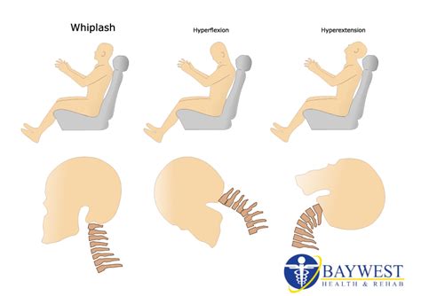 Chiropractic Management of Whiplash - Southern Nevada Chiropractic