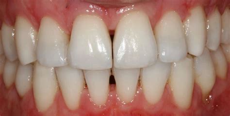 Interproximal Reduction (IPR), aka Polishing or Shaving Teeth Pt1