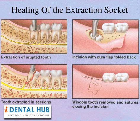 The healing process of the extraction socket starts immediately after the tooth extraction ...