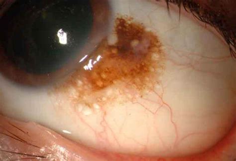 Conjunctival Nevus