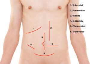 Langer’s Lines and Surgical Incisions - Medical Exam Prep