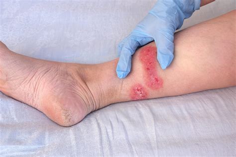 How To Heal Recurring Diabetic Sores On Legs With Amniotic Allografts