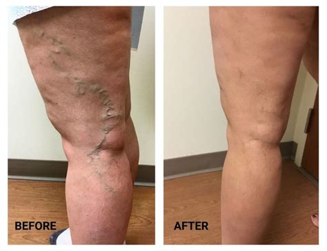 Should I Be Concerned About Dark Veins? - Denver Vein Center