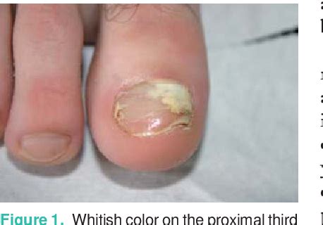 Proximal Subungual Onychomycosis