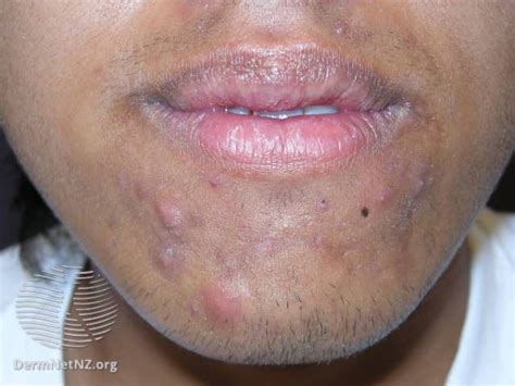 Overview of the Types and Stages of Acne (2023)