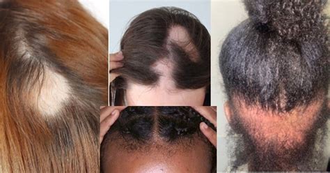 Bald Spot Cover up HD Hair Pieces Covers Bald Spots and Thinning Hair - Etsy