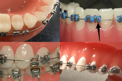 Broken Bracket On Braces? The 3 Things You NEED To Do