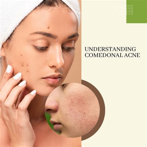 Comedonal Acne: Causes, Treatments, and Prevention Tips | Clinikally