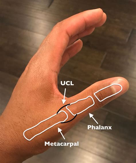 Unraveling the UCL Injury of the Thumb