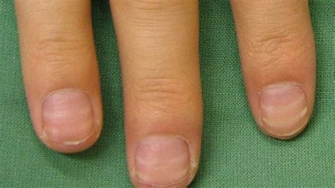 Nail Abnormalities: Symptoms, Causes, and Prevention | You nailed it, Healthy nails, Nail health