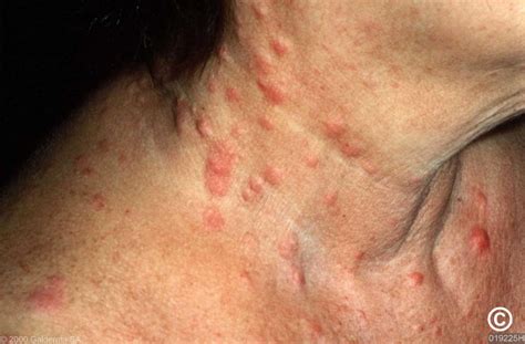 Cutaneous metastases