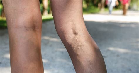 Varicose Veins and Blood Clots in Your Leg | The Iowa Clinic