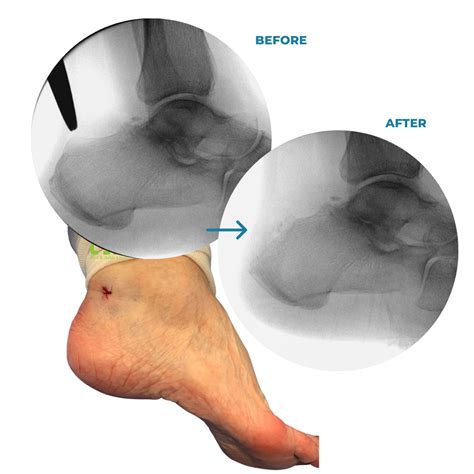 Haglund´s Deformity - CDA Foot and Ankle