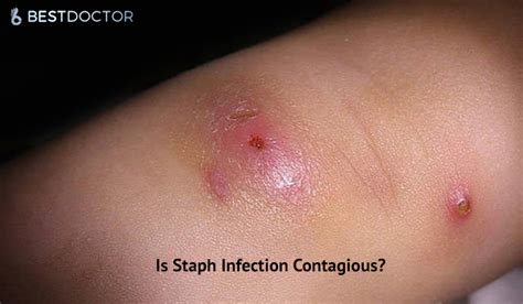 Mild Staph Infection